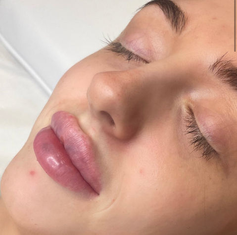 Lip Filler Treatment