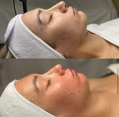 Medical Grade Chemical Peel