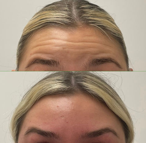Anti Wrinkle Treatment
