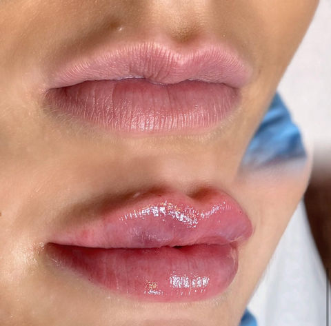 Lip Filler Treatment