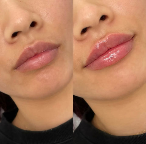 Lip Filler Treatment