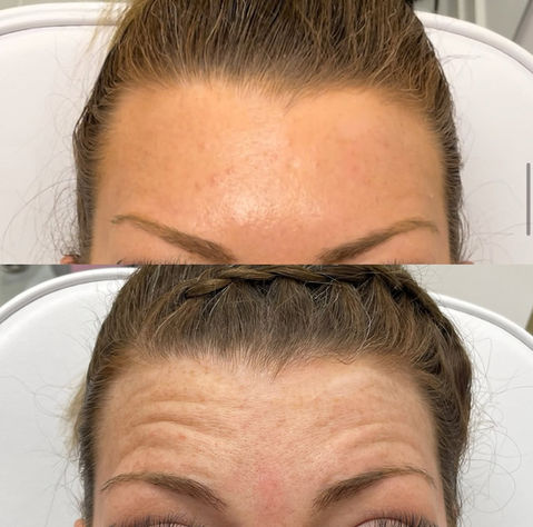 Anti Wrinkle Treatment