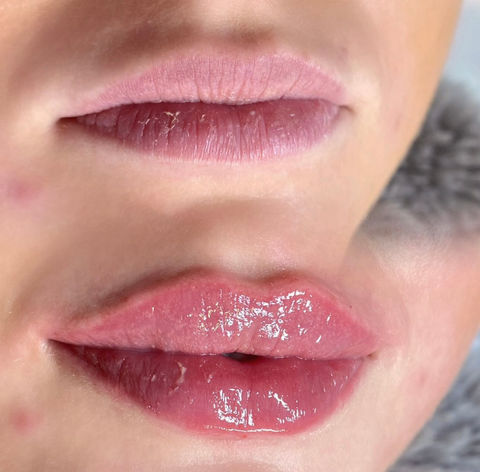 Lip Filler Treatment