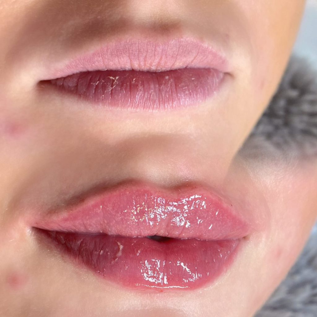 lip filler